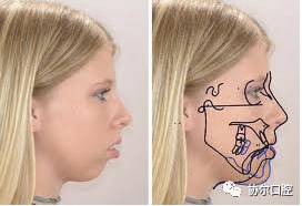 当“龅牙”遇上“小下巴”，你有这样的烦恼吗？