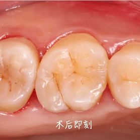 美塑树脂嵌体间接修复左上后牙牙体缺损一例