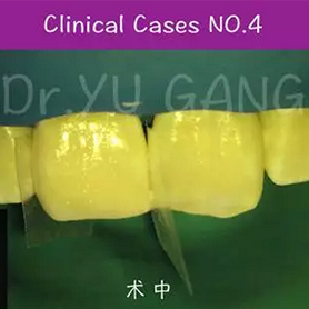 显微微创美塑树脂修复前牙缺损