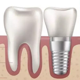 能陪伴你一生的种植牙